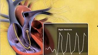 视频导管 国产,创新驱动下的医疗技术突破